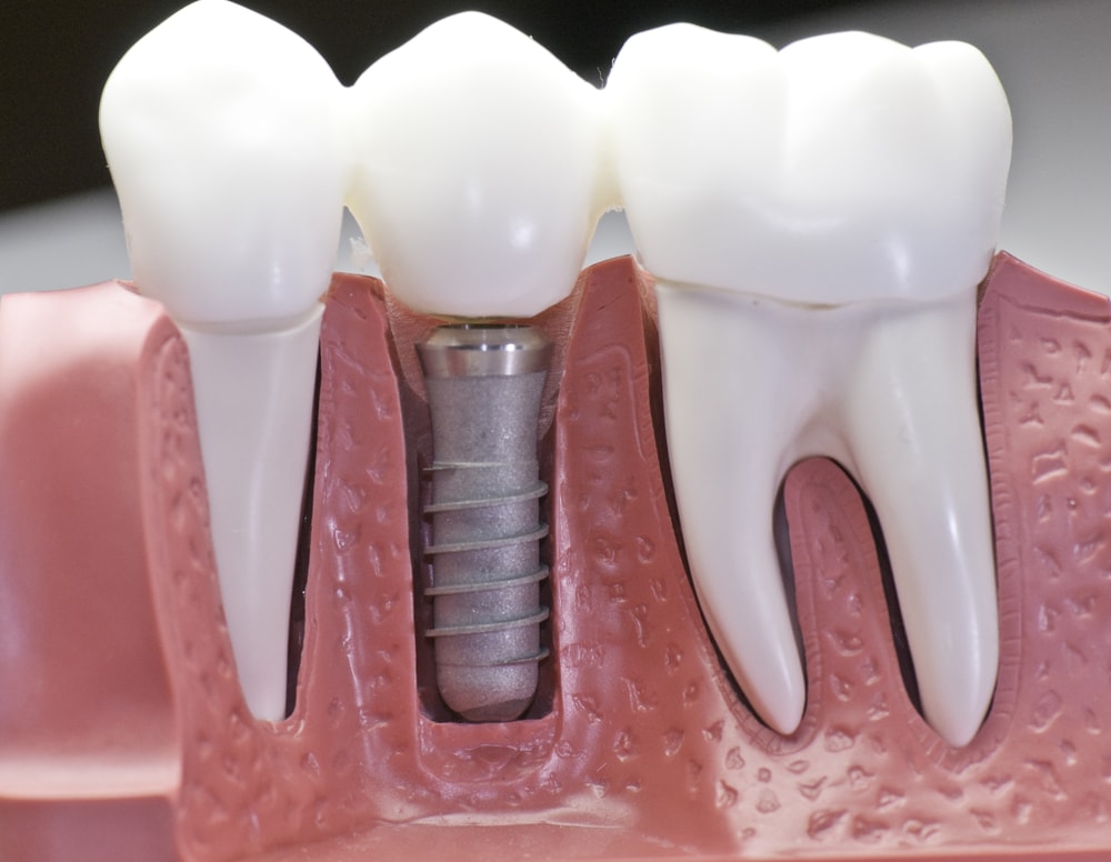 Is A Patient Sedated When Getting Dental Implants? — mypremierimplants