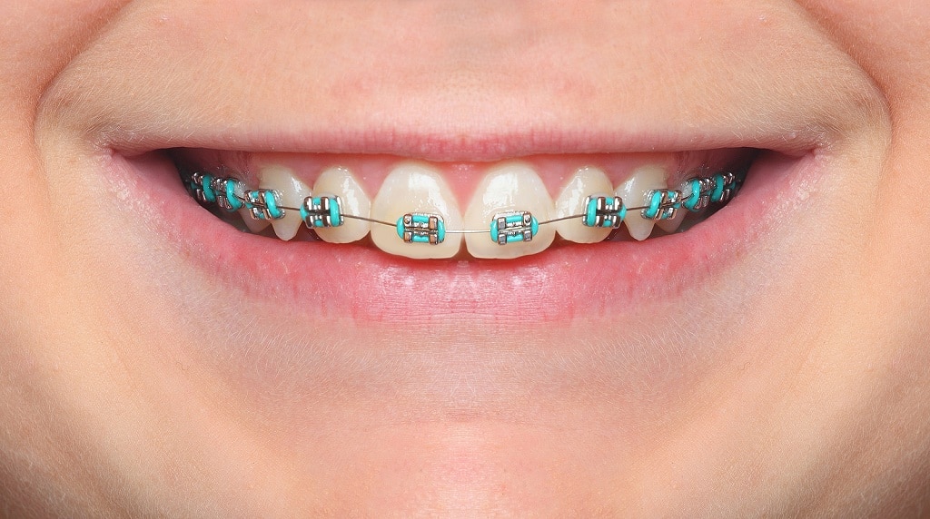 Traditional Metal Braces | Dr. Lucas Orthodontics | South Florida