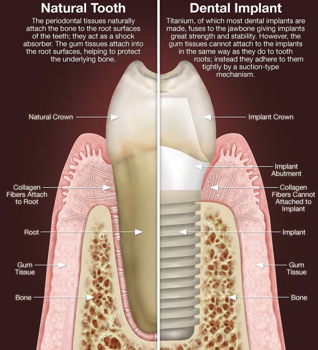 Best Dental Implants Specialist in Lewisville & The Colony Tx