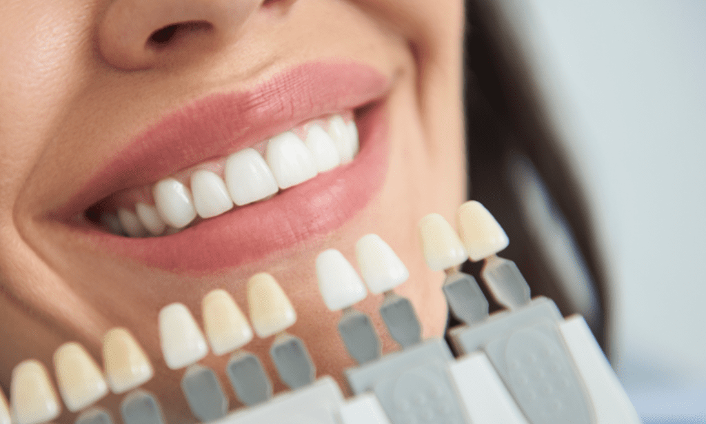 How to Choose the Right Veneer Material for Your Smile Goals.