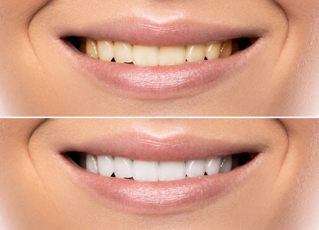 How Can a Dentist Help with Teeth Whitening? | by Samuel F. Jirik, DDS | Medium